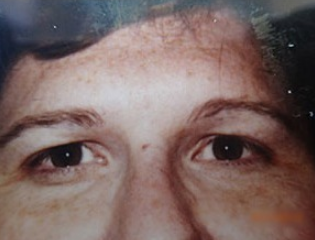 25-34 year old man treated with Facial Feminization Surgery before 1623743