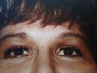 25-34 year old man treated with Facial Feminization Surgery after 1623743