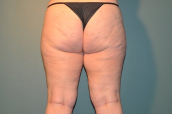 Cellulaze after 1098242