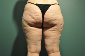 Cellulaze before 1098242
