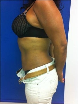 Laser Liposuction after 561227