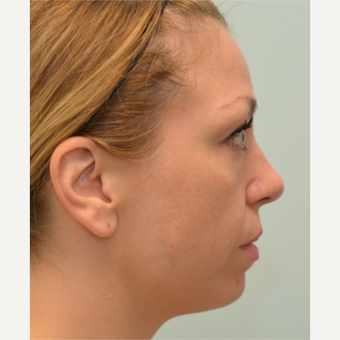34 year old woman treated with Voluma, Restylane, and Dysport before 2585905