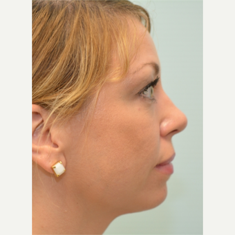 34 year old woman treated with Voluma, Restylane, and Dysport after 2585905