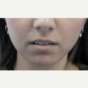 18-24 year old woman treated with Lip Augmentation before 3419631