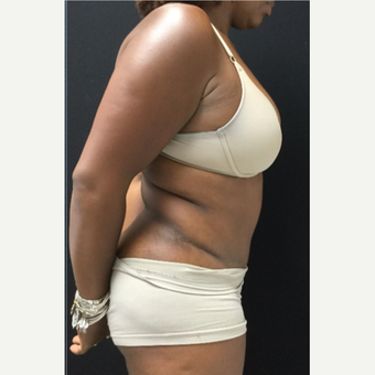 45-54 year old woman treated with Tummy Tuck after 3481542