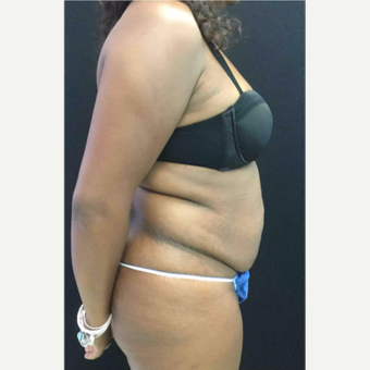 45-54 year old woman treated with Tummy Tuck before 3481542