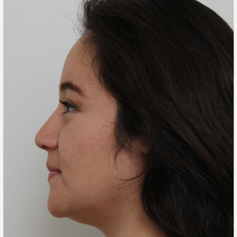 25-34 year old woman treated with Rhinoplasty after 3371691
