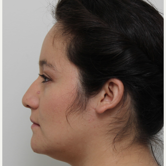 25-34 year old woman treated with Rhinoplasty before 3371691