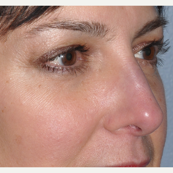 Facial filler to lower eyelid and cheek after 3375023