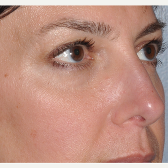 Facial filler to lower eyelid and cheek before 3375023