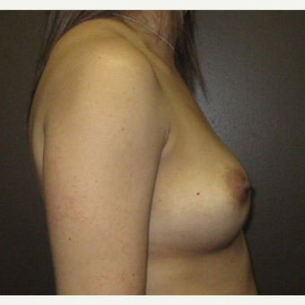 35-44 year old woman treated with Breast Augmentation before 3424564