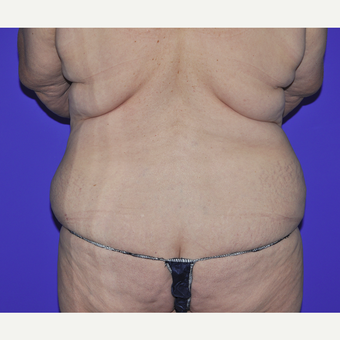 55-64 year old woman treated with Body Lift before 3455258