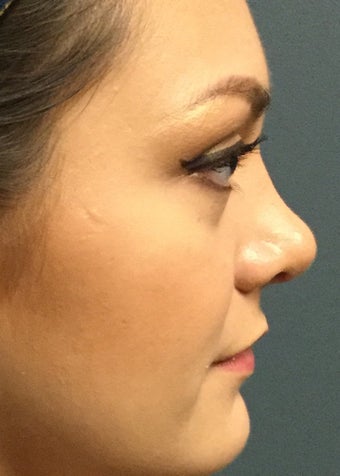18-24 year old woman treated with Rhinoplasty after 2764985