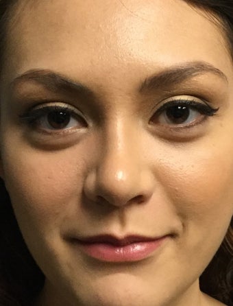 18-24 year old woman treated with Rhinoplasty 2764985
