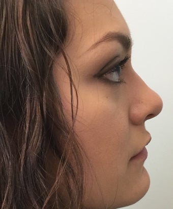 18-24 year old woman treated with Rhinoplasty before 2764985