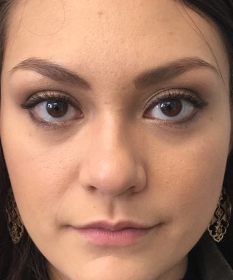 18-24 year old woman treated with Rhinoplasty 2764985