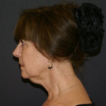55-64 year old woman; facelift, necklift, lower blepharoplasty, and fat transfer before 1878651