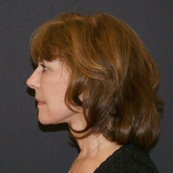 55-64 year old woman; facelift, necklift, lower blepharoplasty, and fat transfer after 1878651
