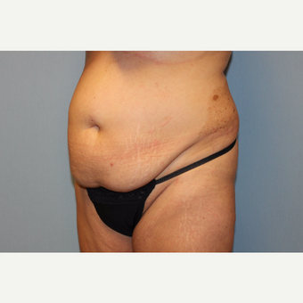 35-44 year old woman treated with Tummy Tuck before 3529142