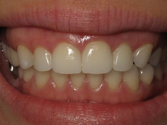 Porcelain Crowns Before & After Photo after 996258
