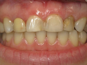 Porcelain Crowns Before & After Photo before 996258