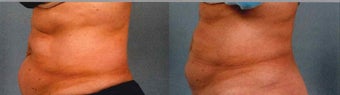 CoolSculpting Results before 1123920