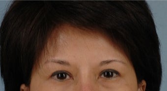 45-54 year old woman treated with Asian Eyelid Surgery before 3615797