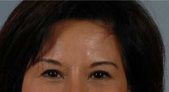 45-54 year old woman treated with Asian Eyelid Surgery after 3615797