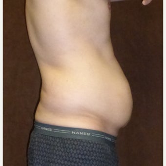 33 year old man treated with Male Tummy Tuck 1813599