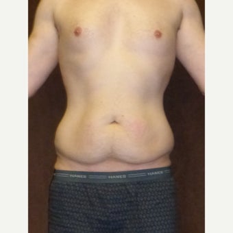 33 year old man treated with Male Tummy Tuck before 1813599