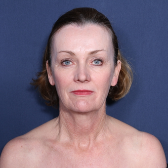55-64 year old woman treated with Neck Lift (view 1 of 2) before 3179920