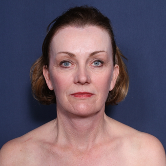 55-64 year old woman treated with Neck Lift (view 1 of 2) after 3179920