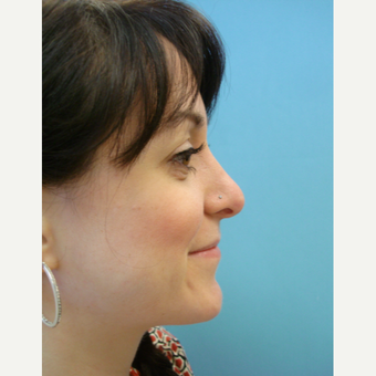 25-34 year old woman treated with Rhinoplasty after 3482550
