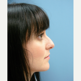 25-34 year old woman treated with Rhinoplasty before 3482550