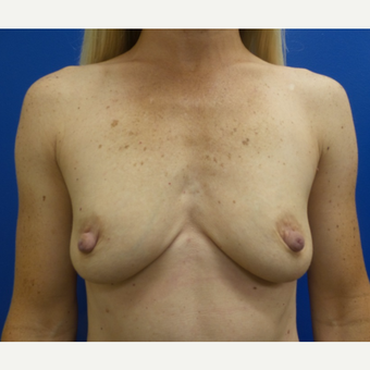 35-44 year old woman treated with Breast Augmentation before 3775675