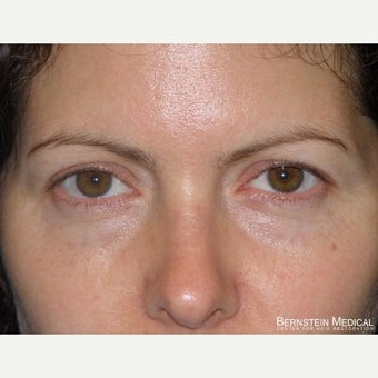 35-44 year old woman treated with Eyebrow Transplant before 1958743