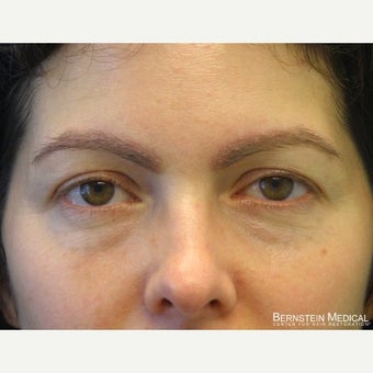 35-44 year old woman treated with Eyebrow Transplant after 1958743