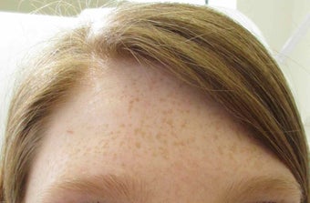 40 year old female treated for frown lines with Botox after 1245354