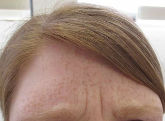 40 year old female treated for frown lines with Botox before 1245354