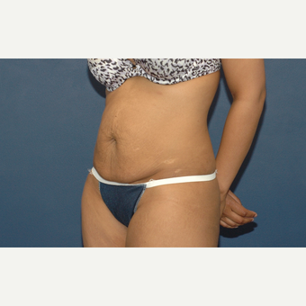 32 year old woman treated with Tummy Tuck before 3283087