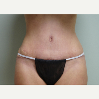 45-54 year old woman treated with Tummy Tuck after 3281518