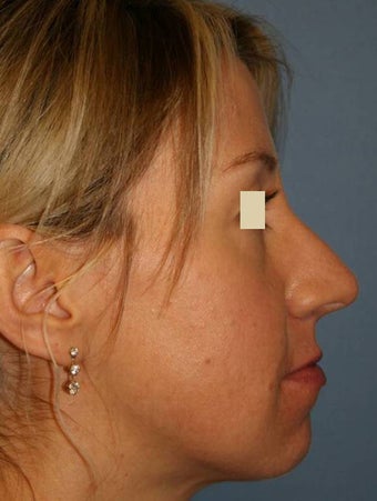 Rhinoplasty before 142575