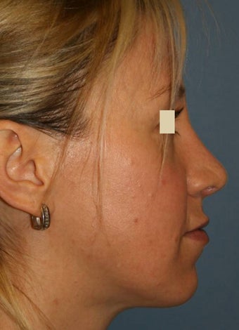 Rhinoplasty after 142575