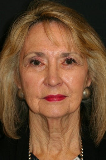 65-74 year old woman treated with Quicklift Plus type Facelift before 1679563