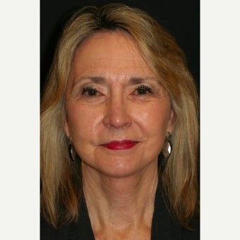 65-74 year old woman treated with Quicklift Plus type Facelift after 1679563