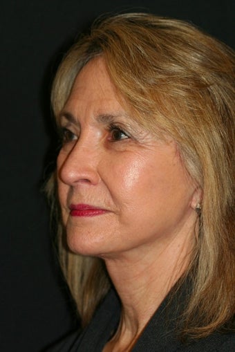 65-74 year old woman treated with Quicklift Plus type Facelift 1679563