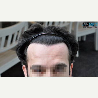 25-34 year old man treated with 3850 Grafts FUE Hair Transplant after 3091509