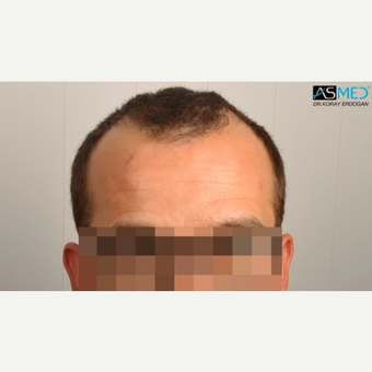 25-34 year old man treated with 3850 Grafts FUE Hair Transplant before 3091509