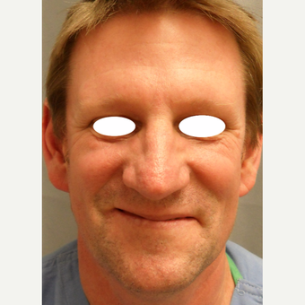 45-54 year old man treated with Septoplasty and Rhinoplasty after 3108779