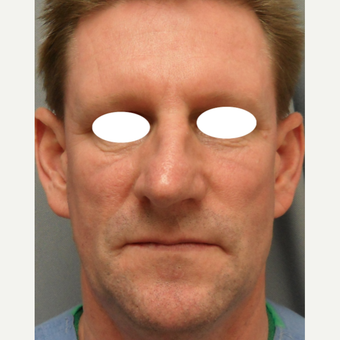 45-54 year old man treated with Septoplasty and Rhinoplasty before 3108779